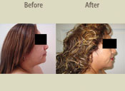 Before & After Photo