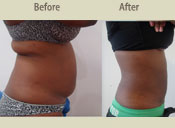 Before & After Photo