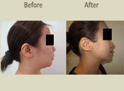 Before & After Photo