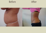 Before & After Photo