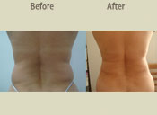 Before & After Photo