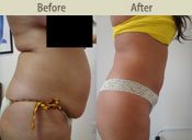 Before & After Photo