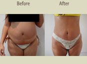 Before & After Photo