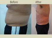 Before & After Photo