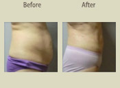 Before & After Photo