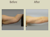 Before & After Photo