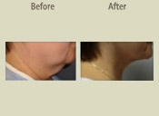 Before & After Photo