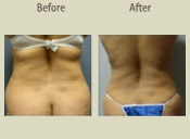 Before & After Photo