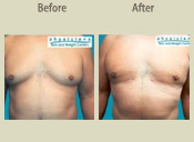 Before & After Photo