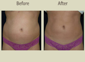 Before & After Photo