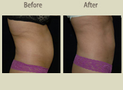 Before & After Photo