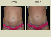 Before & After Photo