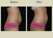 Before & After Photo