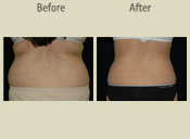 Before & After Photo