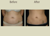 Before & After Photo