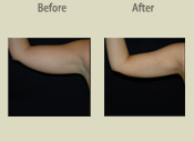 Before & After Photo