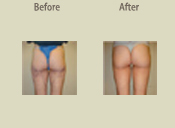 Before & After Photo