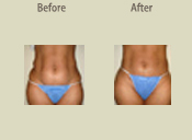 Before & After Photo