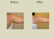 Before & After Photo
