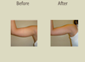 Before & After Photo