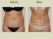 Before & After Photo