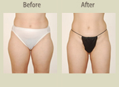 Before & After Photo