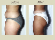 Before & After Photo