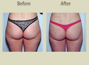 Before & After Photo