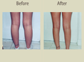 Before & After Photo