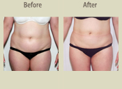 Before & After Photo