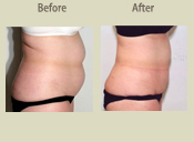 Before & After Photo