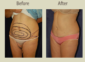 Before & After Photo