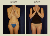 Before & After Photo