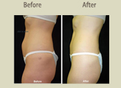 Before & After Photo