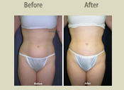 Before & After Photo