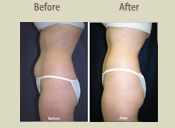 Before & After Photo