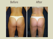Before & After Photo