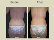 Before & After Photo