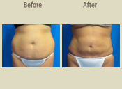 Before & After Photo