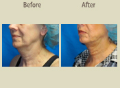 Before & After Photo