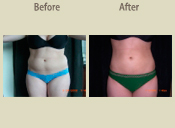 Before & After Photo