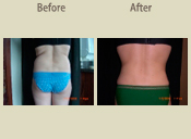 Before & After Photo