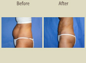 Before & After Photo