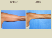 Before & After Photo