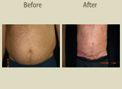 Before & After Photo