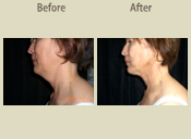 Before & After Photo