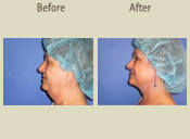 Before & After Photo