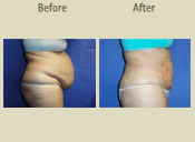 Before & After Photo