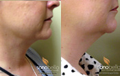 Before & After Photo