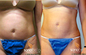Before & After Photo